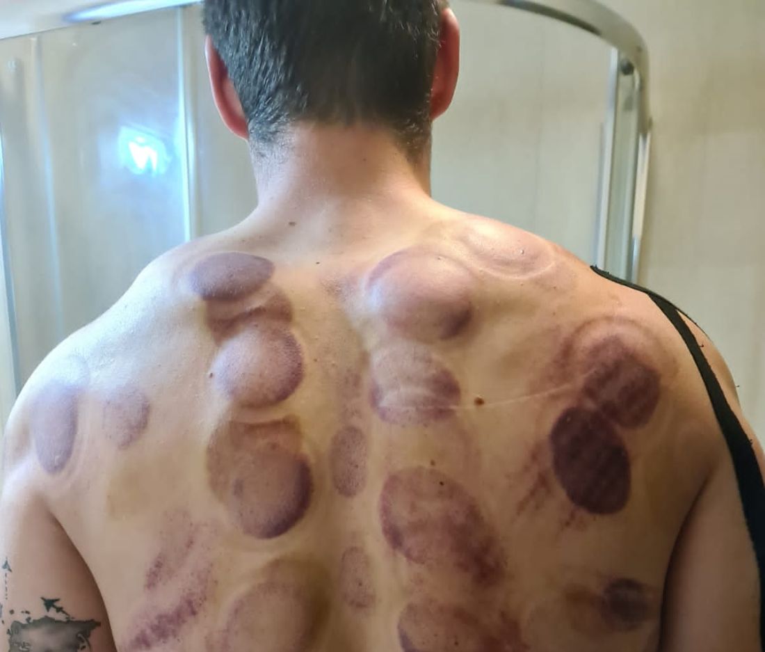 Imagini șocante! Cum arată spatele unui sportiv român calificat la Olimpiada de la Tokyo | GALERIE FOTO