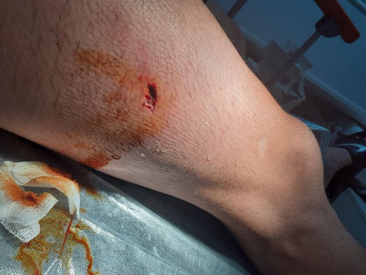 Primul cartonaș roșu, prima accidentare gravă a sezonului în Liga 1: „O să scot copcile peste zece zile! Nu pot să fac nimic”