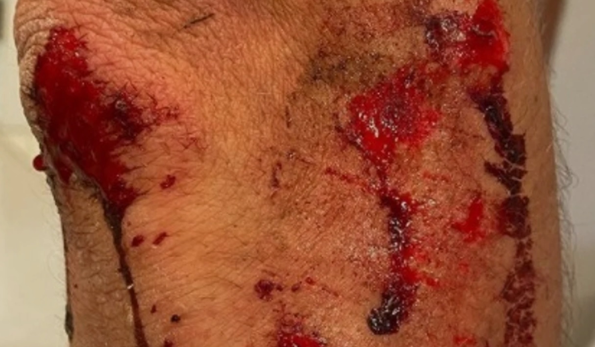 Ciclistul Alexandar Richardson, clipe de coșmar! A fost agresat și jefuit de bărbați mascați: „Au intrat în mine cu motocicleta! Am fost târât o sută de metri!”