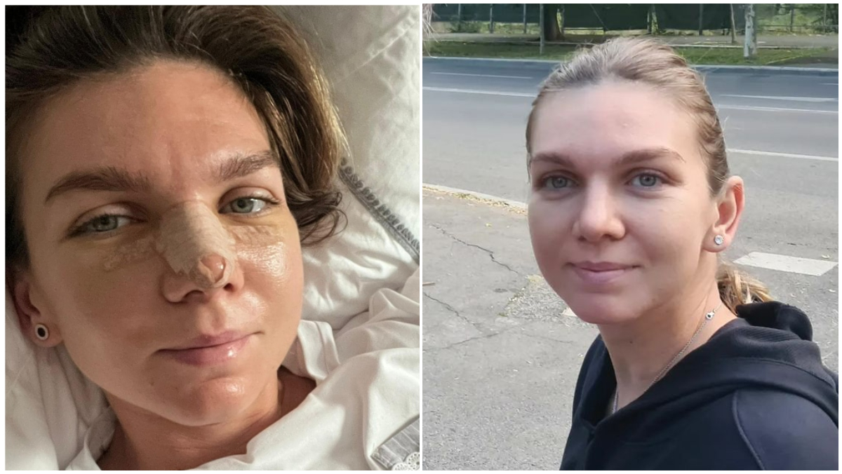 Simona Halep, transformare demențială! Cum arată noul nas al sportivei fără bandaj: a ieșit pe stradă și a făcut senzație | FOTO