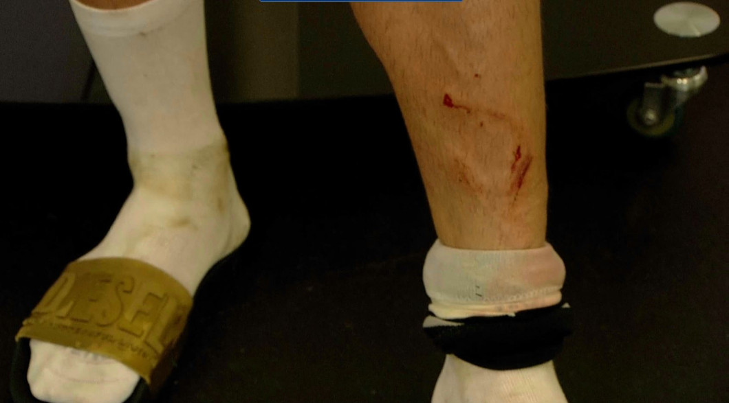 Verdictul medicilor după intrarea horror a lui Yeboah la Fulop! Ultimele vești despre jucătorul Universității Cluj înaintea derby-ului cu FCSB | EXCLUSIV