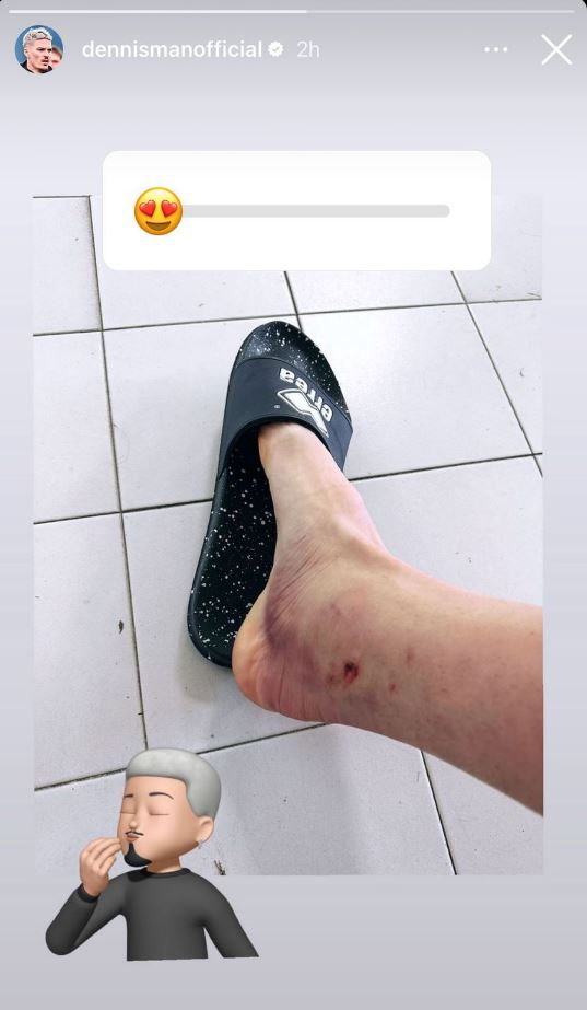 Glezna lui Dennis Man arată groaznic după ultima accidentare suferită de fotbalist. Sursa foto: Instagram.com/dennismanofficial